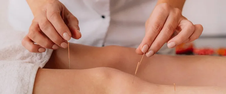 Acupuncture for Stress and Anxiety: A Comprehensive Overview