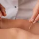Acupuncture for Stress and Anxiety: A Comprehensive Overview