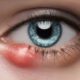 Eye Styes: Effective Home Remedies and Causes Explained